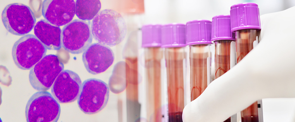The ALC10 study has opened, assessing treatment approaches in older adults with acute myeloid leukemia 