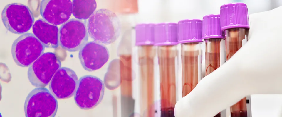 The ALC10 study has opened, assessing treatment approaches in older adults with acute myeloid leukemia 