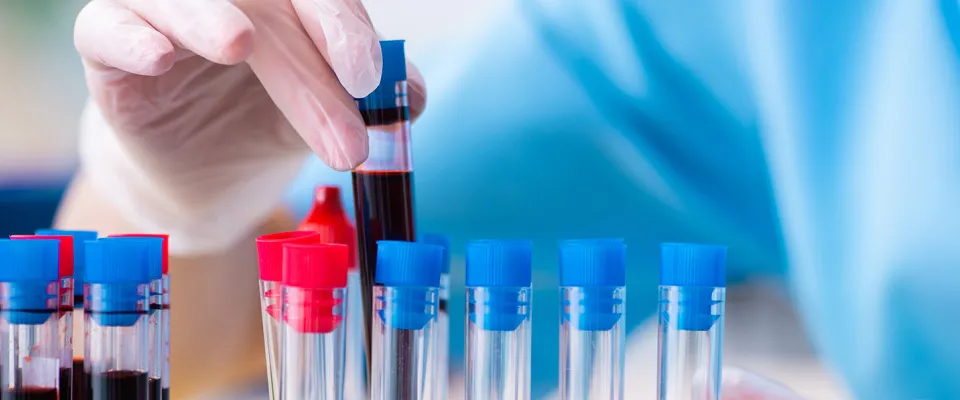 Now open, the SC30 study investigating the role of immunoglobulin