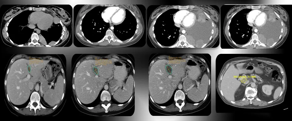 iRECIST - immunotherapy Response Evaluation Criteria in Solid Tumours 